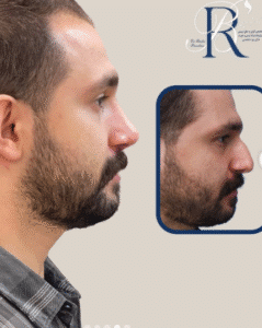 نمونه عمل بینی دکتر بشیر رسولیان