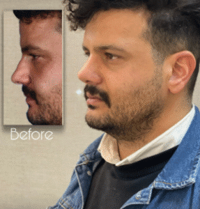 نمونه عمل بینی دکتر بشیر رسولیان