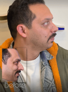 نمونه عمل بینی دکتر بشیر رسولیان