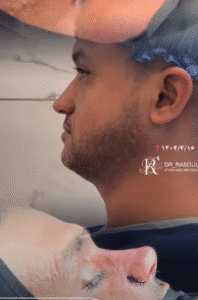 نمونه عمل بینی دکتر بشیر رسولیان