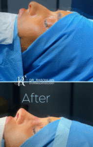 نمونه عمل بینی دکتر بشیر رسولیان