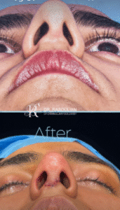 نمونه عمل بینی دکتر بشیر رسولیان