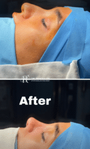 نمونه عمل بینی دکتر بشیر رسولیان