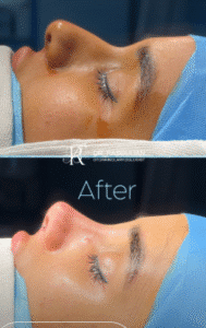 نمونه عمل بینی دکتر بشیر رسولیان