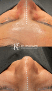 نمونه عمل بینی دکتر بشیر رسولیان