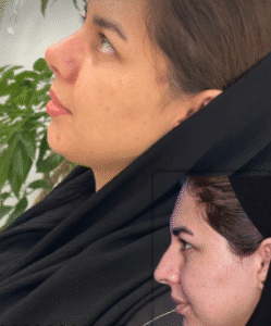 نمونه عمل بینی دکتر بشیر رسولیان