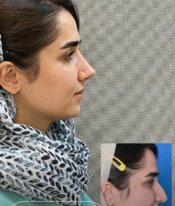 نمونه عمل بینی دکتر بشیر رسولیان