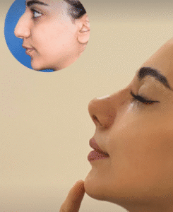 نمونه عمل بینی دکتر بشیر رسولیان