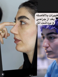 نمونه عمل بینی دکتر وحیده موسوی