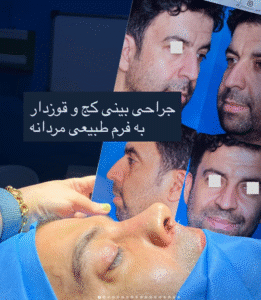 نمونه عمل بینی دکتر وحیده موسوی