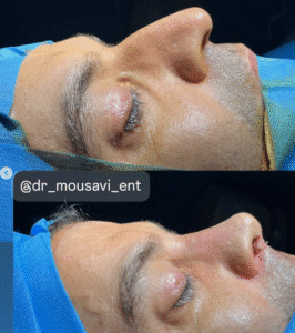 نمونه عمل بینی دکتر وحیده موسوی