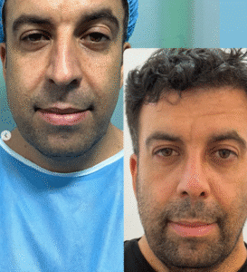 نمونه عمل بینی دکتر وحیده موسوی