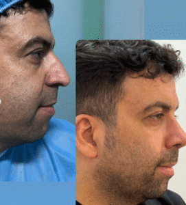 نمونه عمل بینی دکتر وحیده موسوی