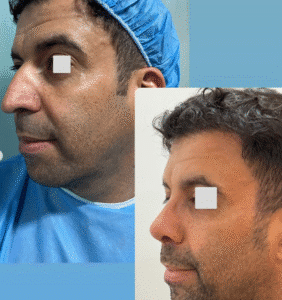 نمونه عمل بینی دکتر وحیده موسوی