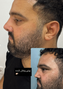 نمونه عمل بینی دکتر وحیده موسوی