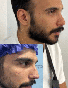 نمونه عمل بینی دکتر وحیده موسوی