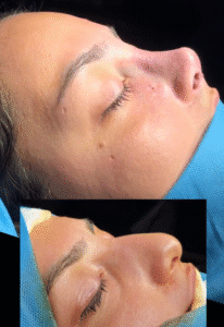 نمونه عمل بینی دکتر وحیده موسوی