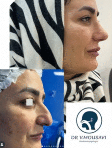 نمونه عمل بینی دکتر وحیده موسوی
