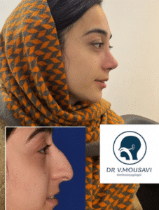 نمونه عمل بینی دکتر وحیده موسوی
