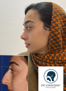 نمونه عمل بینی دکتر وحیده موسوی