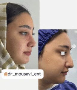 نمونه عمل بینی دکتر وحیده موسوی