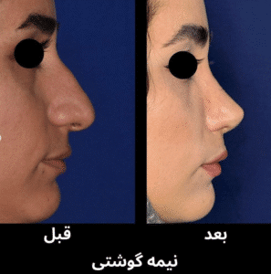 نمونه عمل بینی دکتر محمد اکبریان