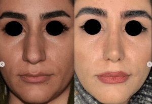 نمونه عمل بینی دکتر محمد اکبریان