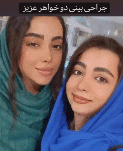 نمونه عمل بینی دکتر محمد اکبریان