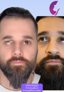 نمونه عمل بینی دکتر اسماعیل فرزادفرد