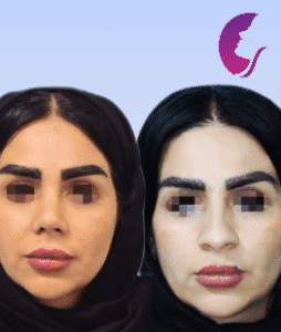 نمونه عمل بینی دکتر اسماعیل فرزادفرد