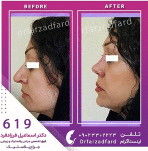 نمونه عمل بینی دکتر اسماعیل فرزادفرد