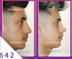 نمونه عمل بینی دکتر اسماعیل فرزادفرد