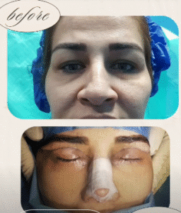 نمونه عمل بینی دکتر پریسا نظرپور