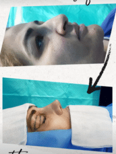 نمونه عمل بینی دکتر پریسا نظرپور