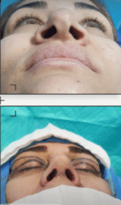 نمونه عمل بینی دکتر پریسا نظرپور