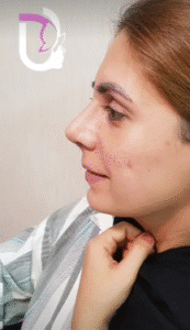 نمونه عمل بینی دکتر پریسا نظرپور