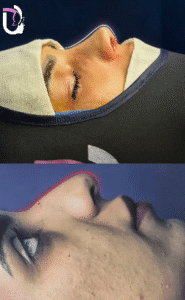 نمونه عمل بینی دکتر پریسا نظرپور