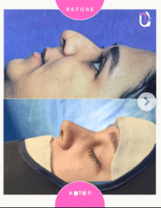 نمونه عمل بینی دکتر پریسا نظرپور