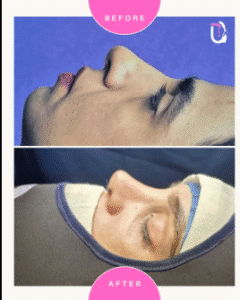 نمونه عمل بینی دکتر پریسا نظرپور