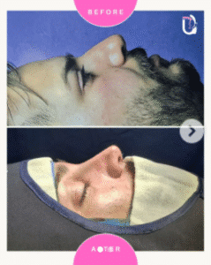 نمونه عمل بینی دکتر پریسا نظرپور