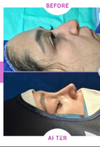 نمونه عمل بینی دکتر پریسا نظرپور