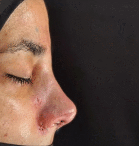 نمونه عمل بینی دکتر مسعود ناصری صدر