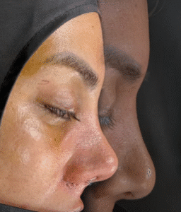 نمونه عمل بینی دکتر مسعود ناصری صدر