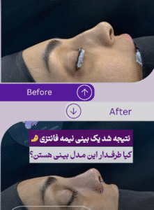 نمونه عمل بینی دکتر مسعود ناصری صدر