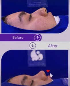 نمونه عمل بینی دکتر مسعود ناصری صدر