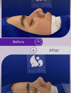 نمونه عمل بینی دکتر مسعود ناصری صدر