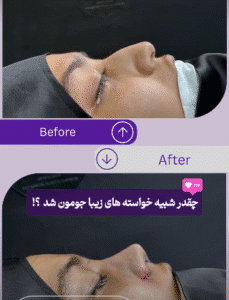 نمونه عمل بینی دکتر مسعود ناصری صدر