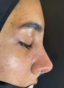 نمونه عمل بینی دکتر مسعود ناصری صدر