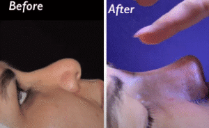 نمونه عمل بینی دکتر مسعود ناصری صدر