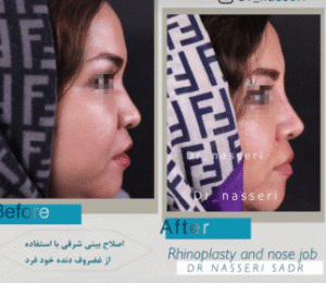 نمونه عمل بینی دکتر مسعود ناصری صدر